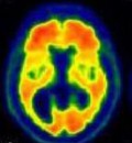 Study Finds Common Alzheimer’s Drug Not Effective To Treat Early to Moderate Alzheimer’s