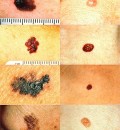 Screening for Melanoma Found Most Effective in Patients 50 Years or Older
