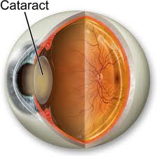 Cataract (image courtesy of Wikipedia)